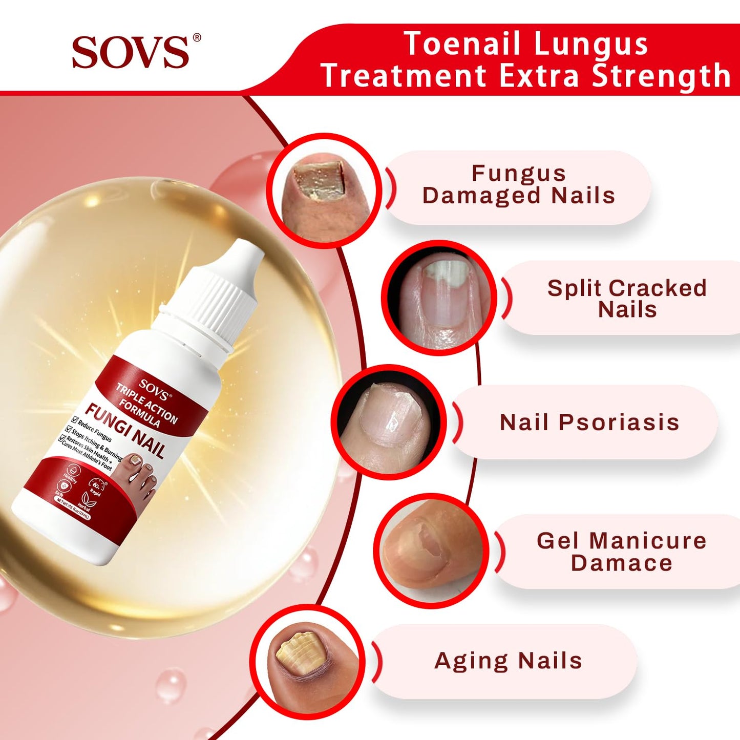SOVS Fungi Nail Toenail Treatment Liquid – Gentle Formula for Beautiful Nails (2Pcs, 1oz)